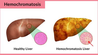 Causes Of Hemochromats Disease When the iron is taken