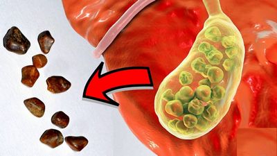 Getting Rid of Gallstones Naturally cholesterol and fats, and will