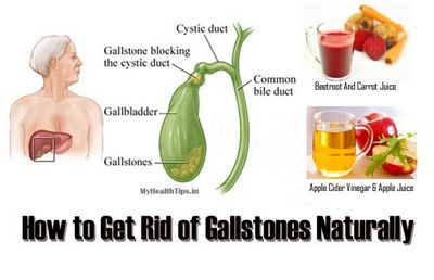 Getting Rid of Gallstones Naturally liver failure, and pancreatic cancer