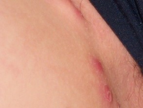 Hidradenitis Suppurativa - What Is It? is the