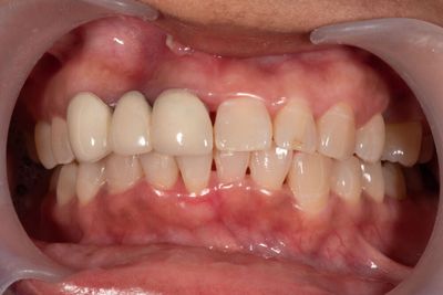 How To Treat Tooth Abscesses? problems, tooth