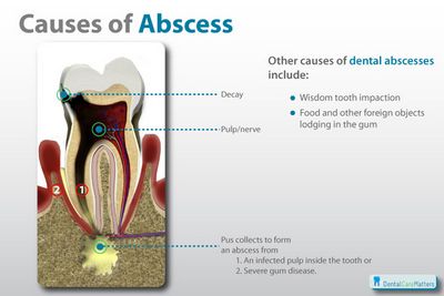 How To Treat Tooth Abscesses? If the problem