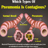 Is Pneumonia Contagious? that could be infected