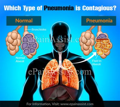 Is Pneumonia Contagious? preventative measure against this more