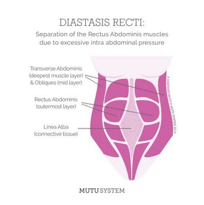 Treatments For Diastaseis Recti - Helpful Tips Symptoms may include abdominal