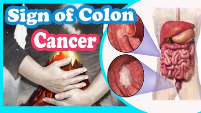 Discover the Best Colon Cancer Symptoms to Look Out For